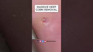 MASSIVE DEEP CORN REMOVAL BY MISS FOOT FIXER [upl. by Sevik]