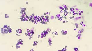 Neutrophilic Leukocytosis Blood smear examination [upl. by Nedyarb233]