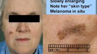 Melanoma Early Detection [upl. by Kemp]