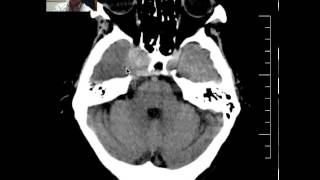 Head CT of Meningioma DISCUSSION by radiologist [upl. by Suriaj]