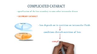 complicated cataract  neet pg notes [upl. by Enedan878]