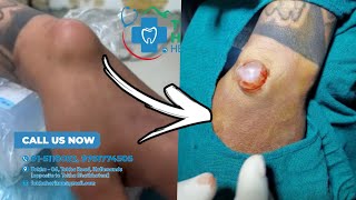 ganglion cyst removal  dr bijay  tokha horizon [upl. by Arotahs813]