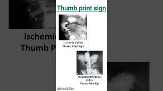 Thumb print sign on xray  viralvideo thumbprint xray [upl. by Charity]