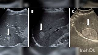 Liver Hemangioma [upl. by Laurette87]