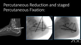 From MIS to mis Evolution of Calcaneal Fracture Management [upl. by Buxton]