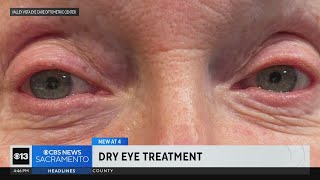 Recenly approved FDA technique proving good treatment for dry eyes [upl. by Mcintyre789]