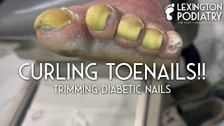 Curling Toenails Trimming Diabetic Nails [upl. by Luapnhoj390]