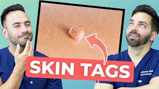 HOW TO TREAT SKIN TAGS LIKE A DERMATOLOGIST [upl. by Yahsal]