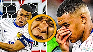 Mbappe broke his nose vs Austria 😱 [upl. by Toll]