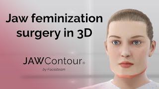 JAWContour®  3D Precision in Jaw and Chin Feminization Surgery [upl. by Dupre640]