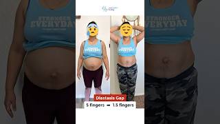 68 kgs  61 kgs Weight Loss Hernia and Diastasis Recti case [upl. by Euqinu742]