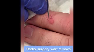 Wart Removal by Radiosurgery  Quick amp Thorough Removal of Stubborn Finger Warts [upl. by Weirick]