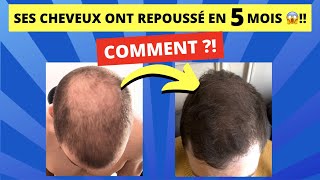 Son SECRET pour faire repousser ses cheveux en 5 mois 😱et en finir avec la calvitie [upl. by Leanne]