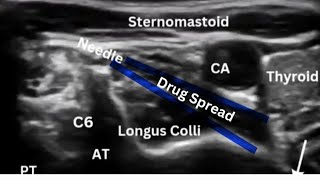 Stellate Ganglion Block for CRPS [upl. by Carlisle325]