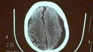 Subdural hematoma [upl. by Matusow]