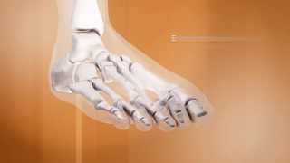 4 Lhallux valgus histoire évolutive et complications  Dr Coillard  Dr Boublil  Dr Grisard [upl. by Innoj]