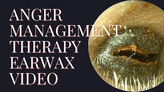 Anger Management Therapy Earwax Video [upl. by Oswal]