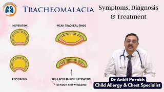 Tracheomalacia in children Symptoms Diagnosis amp Treatment I Dr Ankit Parakh Child Pulmonologist [upl. by Yci20]