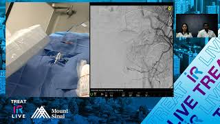 Transradial Prostate Artery Embolization using nBCA Glue for Benign Prostatic Hyperplasia BPH [upl. by Kosse]