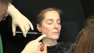 Liquid Facelift – Video Unterspritzung mit Hyaluronsäure – Zeitraffer Facelift ohne OP [upl. by Mcmahon356]