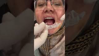 Zirkonyum diş laminediş implant dentistry [upl. by Aspa445]