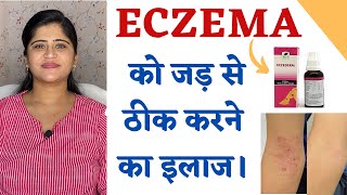 Eczema Treatment ॥ Skin Allergy और Eczema को जड़ से ठीक करने का इलाज ॥ [upl. by Rose239]