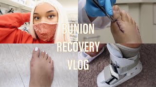 BUNION RECOVERY VLOG 2 Getting Stitches Taken Out  Pain  Swelling  New Boot [upl. by Fayette]