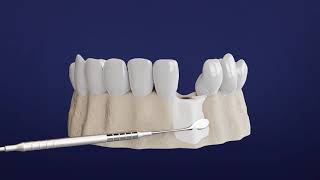 How Long Does It Take to Recover from a Dental Bone Graft [upl. by Isiad]