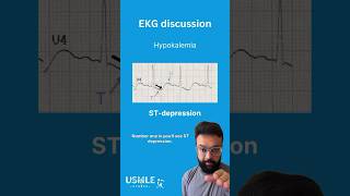 Hypokalemia and EKG Changes Understanding ST Depression T Wave Inversion and Prominent U Waves [upl. by Magena258]