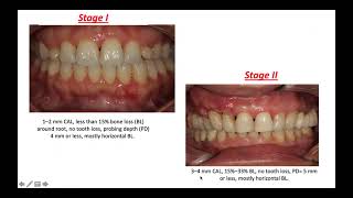 Periodontitis Staging and Grading Dr Diana Mostafa [upl. by Haras]