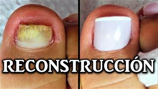 reconstruccion de uñas de pies con acrilico  nail reconstruction  reconstrução de unhas acrílico [upl. by Relyt]