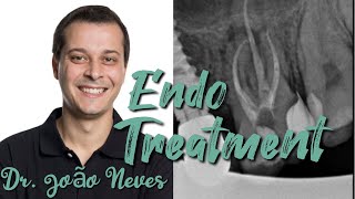 Endo treatment steps DrJoão Neves [upl. by Tiersten]