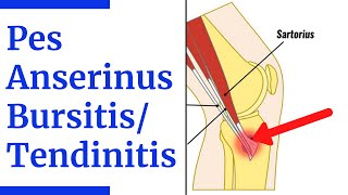 Pes Anserine BursitisTendinitis Evaluation [upl. by Namsu]