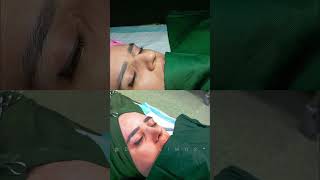 CONTOURING NOSE SURGERY [upl. by Enidlareg32]