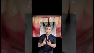 The secret to strong enamel revealed  Preventing enamel erosions expert tips delhidentist [upl. by Fulviah]