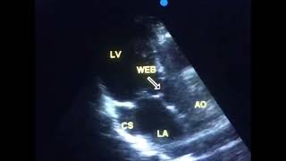 Sub aortic stenosis is it a congenital heart disease  to drahmadmirdamadisiKiJIzZBvYvqoKkZ [upl. by Otreblaug212]