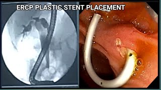 ERCP Plastic stent Placement BDENDOSCOPY [upl. by Verbenia]