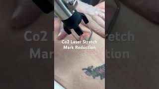 Stretch Marks and Loose Skin  Co2 Laser [upl. by Annocahs]