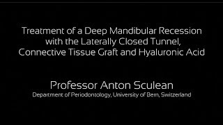 Prof Anton Sculeans treatment of a deep mandibular recession with crosslinked hyaluronic acid gel [upl. by Rostand]