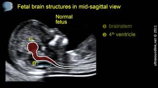 Open spina bifida at 1113 weeks gestation brainstem [upl. by Robbins]