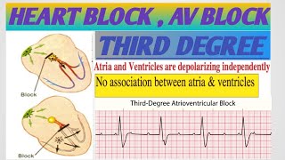 THIRD DEGREE HEART BLOCKAV BLOCKATRIOVENTRICULAR BLOCKأنسداد الدفيرة الكهربائيةأحصار القلب [upl. by Olnek]