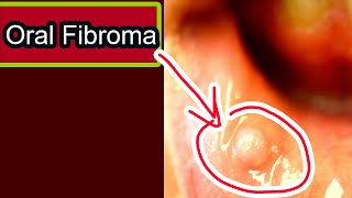 Oral Fibroma Symptoms causes treatment [upl. by Alburg]