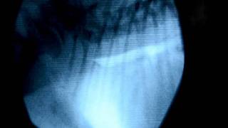 Colapso traqueal fluoroscopia y endoscopia [upl. by Faxun]