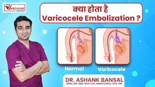 Varicocele Embolization in hindi Treatment for Varicoceles  Dr Ashank Bansal [upl. by Orlov]