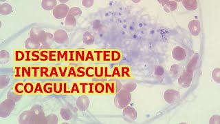 DISSEMINATED INTRAVASCULAR COAGULATION LAB TESTS [upl. by Eislel]