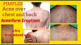 Pimples on chest and back or Acneiform Eruptions aka Drug induced acne  with Teratogenic Drugs [upl. by Ardekan261]