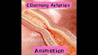 COronary Arteries stunting viralshort doctor hospitalsupplies [upl. by Anselm]