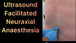 Ultrasound Guided Neuraxial Anaesthesia  step by step how to do it easy and simple👍👌 [upl. by Thaddaus]