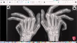 Introduction to Imaging of Arthritis [upl. by Katlin]