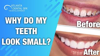 How to FIX small looking teeth [upl. by Ellwood]